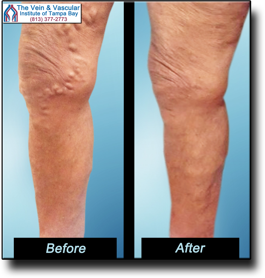 Get Rid Varicose Veins Naturally - Varicose Veins Surgery Clipart (1120x1157), Png Download