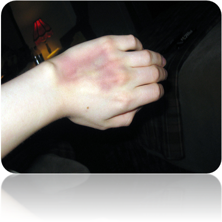 Ivhand-bruise - Netbook Clipart (446x695), Png Download