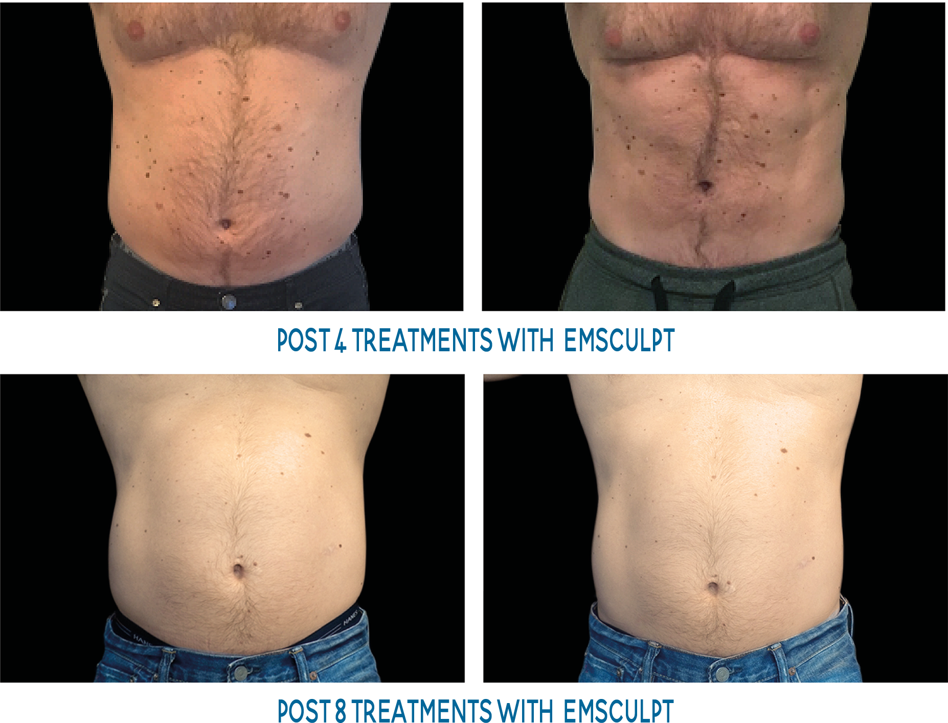 Male Abs Before And After - Emsculpt Before And After Men Clipart (1854x1414), Png Download