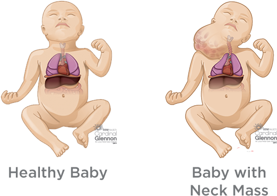Fetal Neck Masses - Fetal Teratoma Neck Clipart (620x520), Png Download