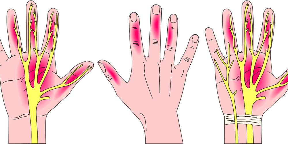 Carpal Tunnel Syndrome Painting Clipart (1000x500), Png Download