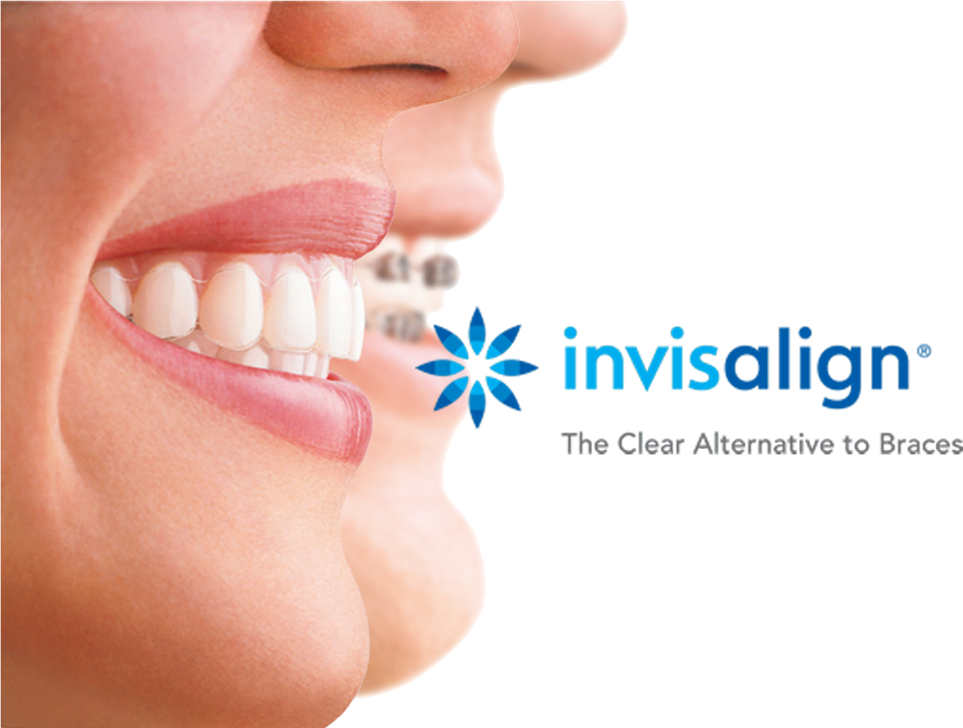 //cdn2 - Hubspot - - Clear Aligners Clipart (1423x1050), Png Download