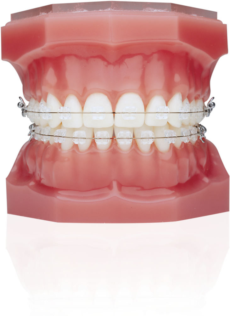 Ice Clear Braces Clipart (812x1025), Png Download