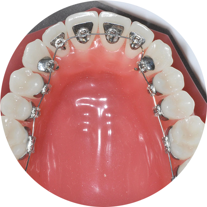 Lingual Braces - Orthodontics Clipart (687x687), Png Download