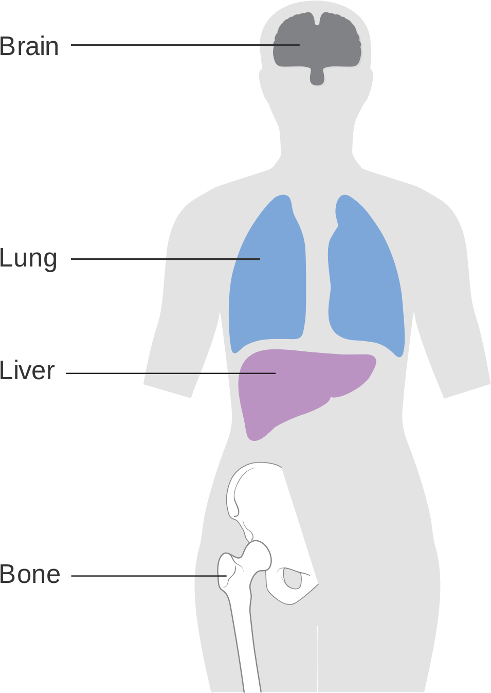 Breast Cancer Metastasis Clipart (1200x1488), Png Download