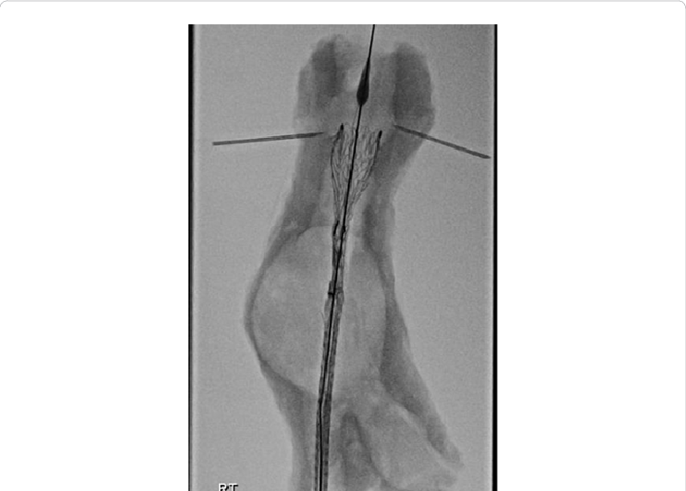 Fluoroscopy Of Stent Graft Inside A Silicone Shell - Figure Drawing Clipart (761x545), Png Download