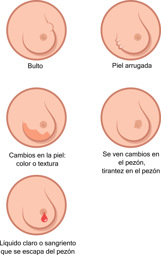 Breast Cancer Illustration Es - El Pezón Sangriento Clipart (542x857), Png Download
