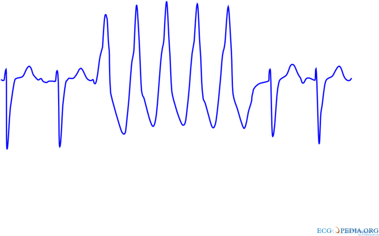 Ventricular Tachycardia 2 - Nsvt Ecg Clipart (800x600), Png Download