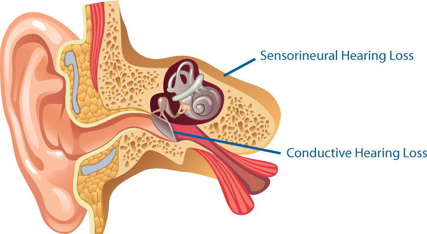 Loss Png - Types Of Hearing Loss Clipart (876x480), Png Download