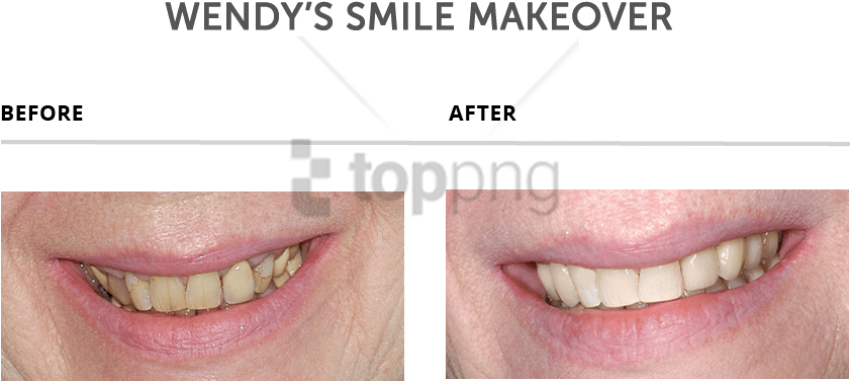 Free Png Download Teeth Makeover Png Images Background - Teeth Makeover Clipart (850x381), Png Download