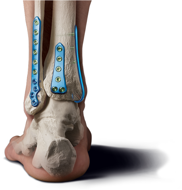 Medline Ankle Fracture Set Clipart (800x622), Png Download