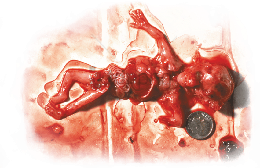 Free Png Download Not Your Body Abortion Meme Png Images - Marie Stopes Abortion Kenya Clipart (850x567), Png Download