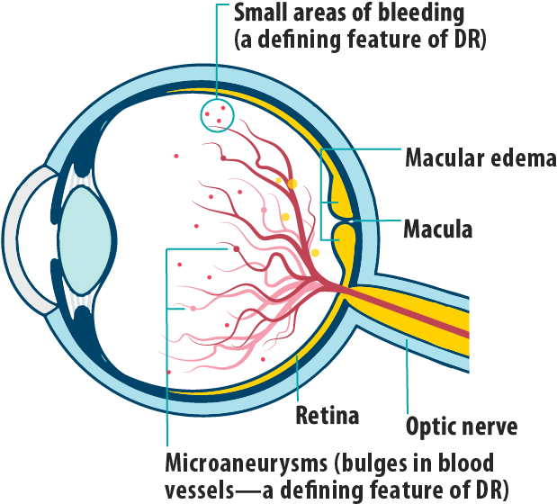 Picture Of Effects Of Dme/dr In Dme On The Eye, Showing - Central Retina Vein Occlusion Vs Clipart (782x705), Png Download