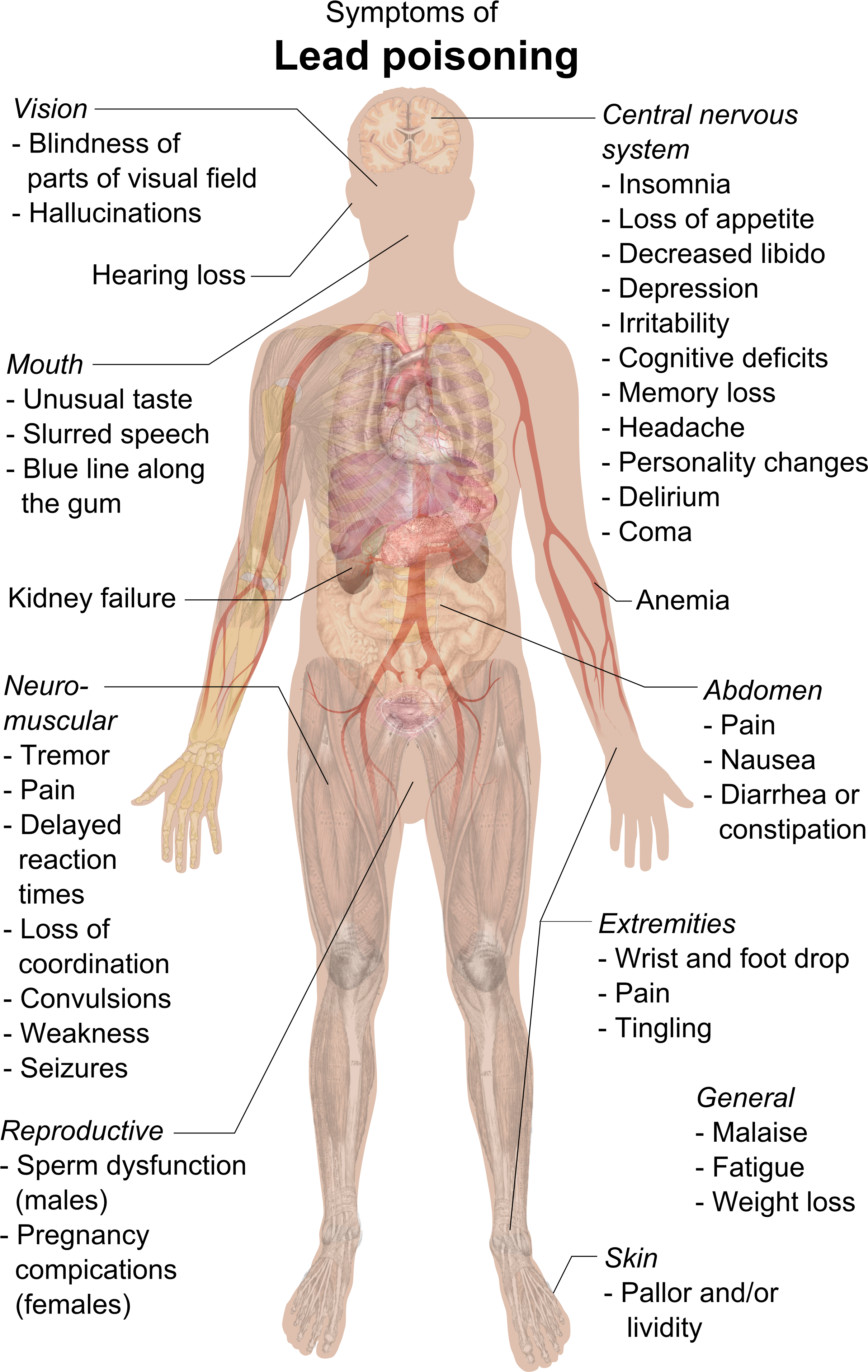 Symptoms Of Lead Poisoning - Lead Poisoning Symptoms Clipart (2500x3883), Png Download