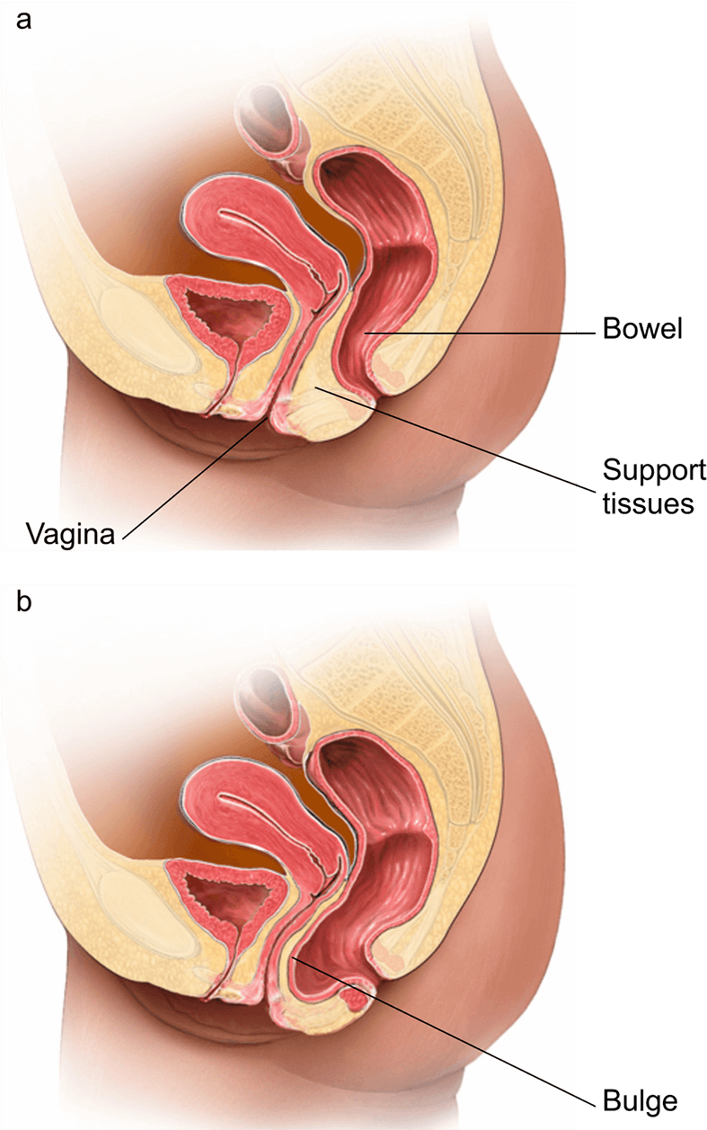 Illustration Showing A Normal Vagina And One With A - Posterior Prolapse Clipart (800x1257), Png Download