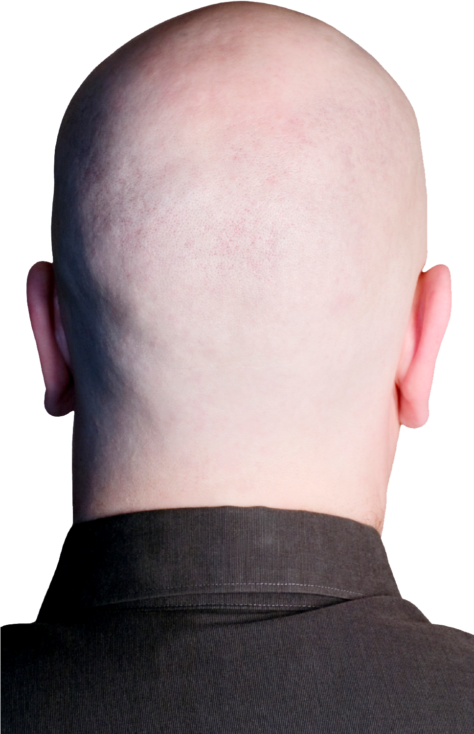 See Original Image Bald Person, Bald Heads, Hair Transplant, - Back Of Bald Head Transparent Clipart (968x1525), Png Download