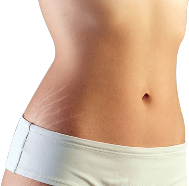 Stretch Marks , Png Download Clipart (717x708), Png Download