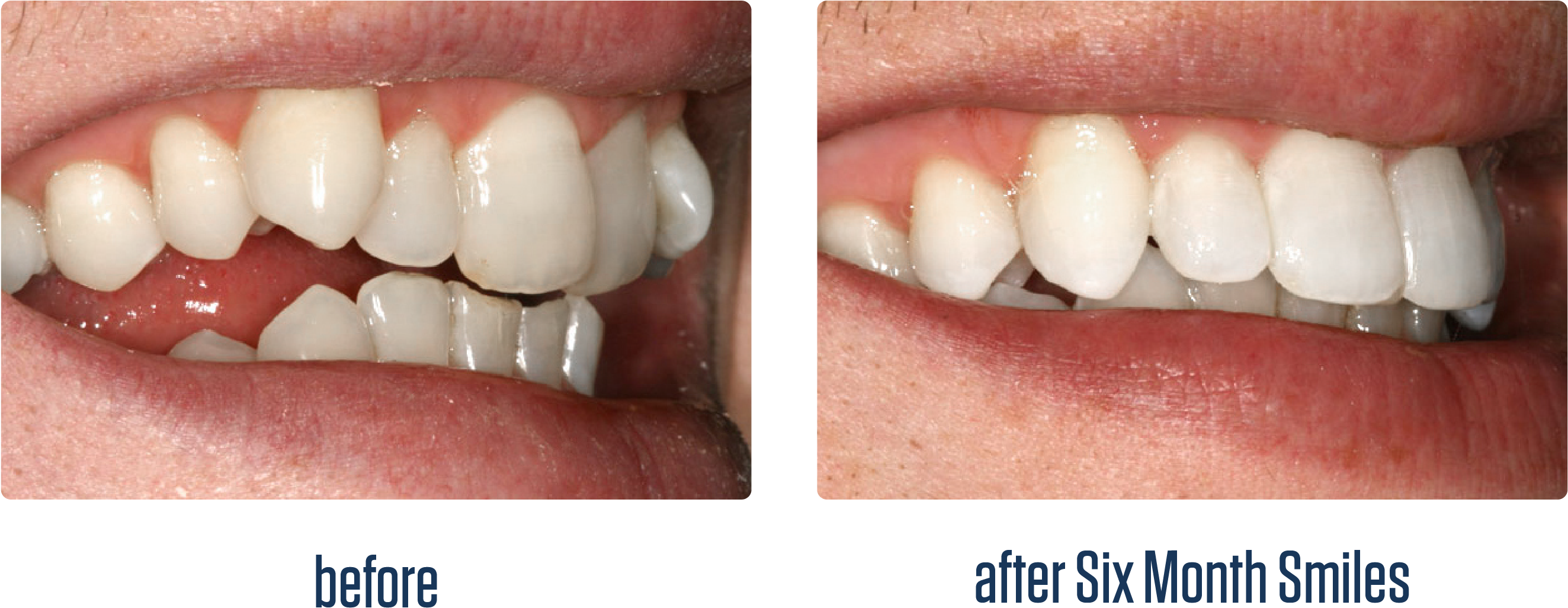Smile Teeth Png - Straight Smile Clipart (3300x1431), Png Download