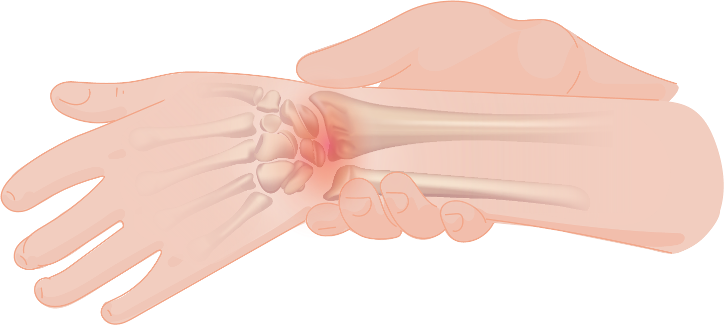 Wrist Pain - Glove Clipart (2000x1413), Png Download