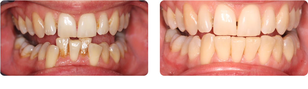 Fast Braces 4 Months - Macro Photography Clipart (1024x304), Png Download