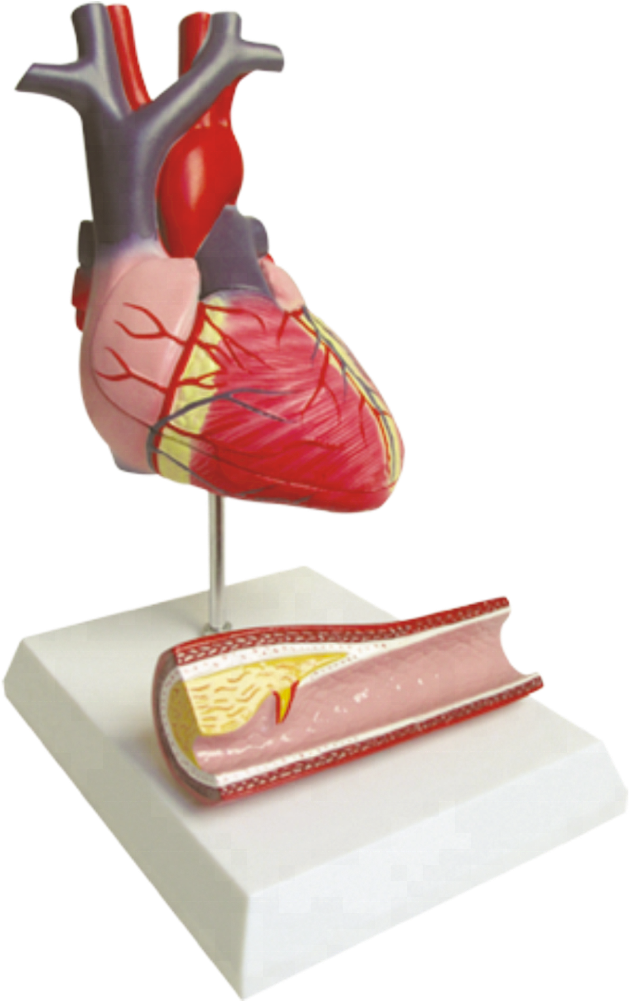 Diseased Heart Model, Diseased Heart Model Suppliers - Figurine Clipart (1000x1000), Png Download