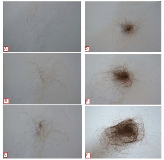 Hair Shedding Scale - Dandelion Clipart (850x665), Png Download