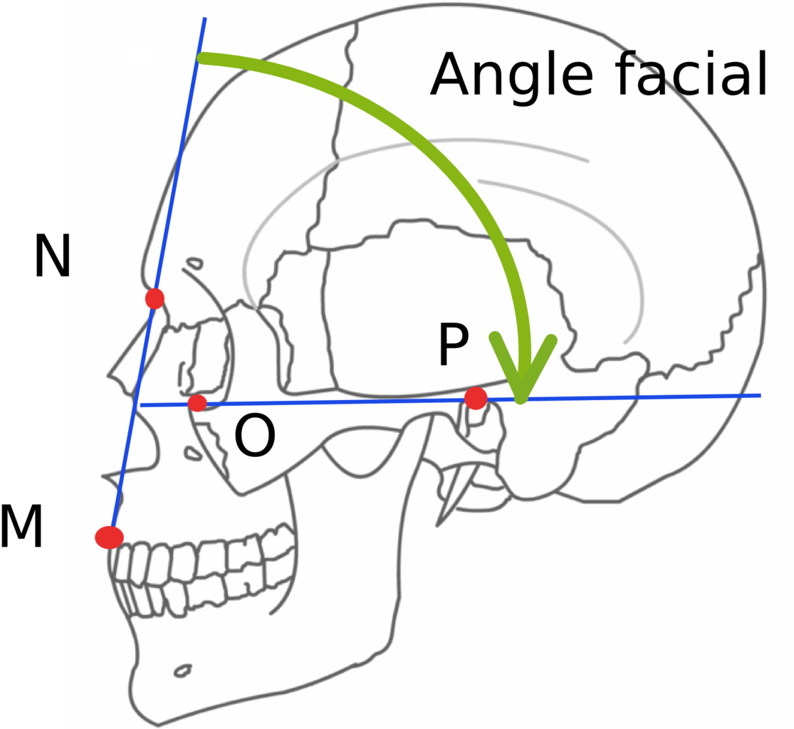 Angle Facial - Lefort 1 Fracture Line Clipart (1115x1024), Png Download