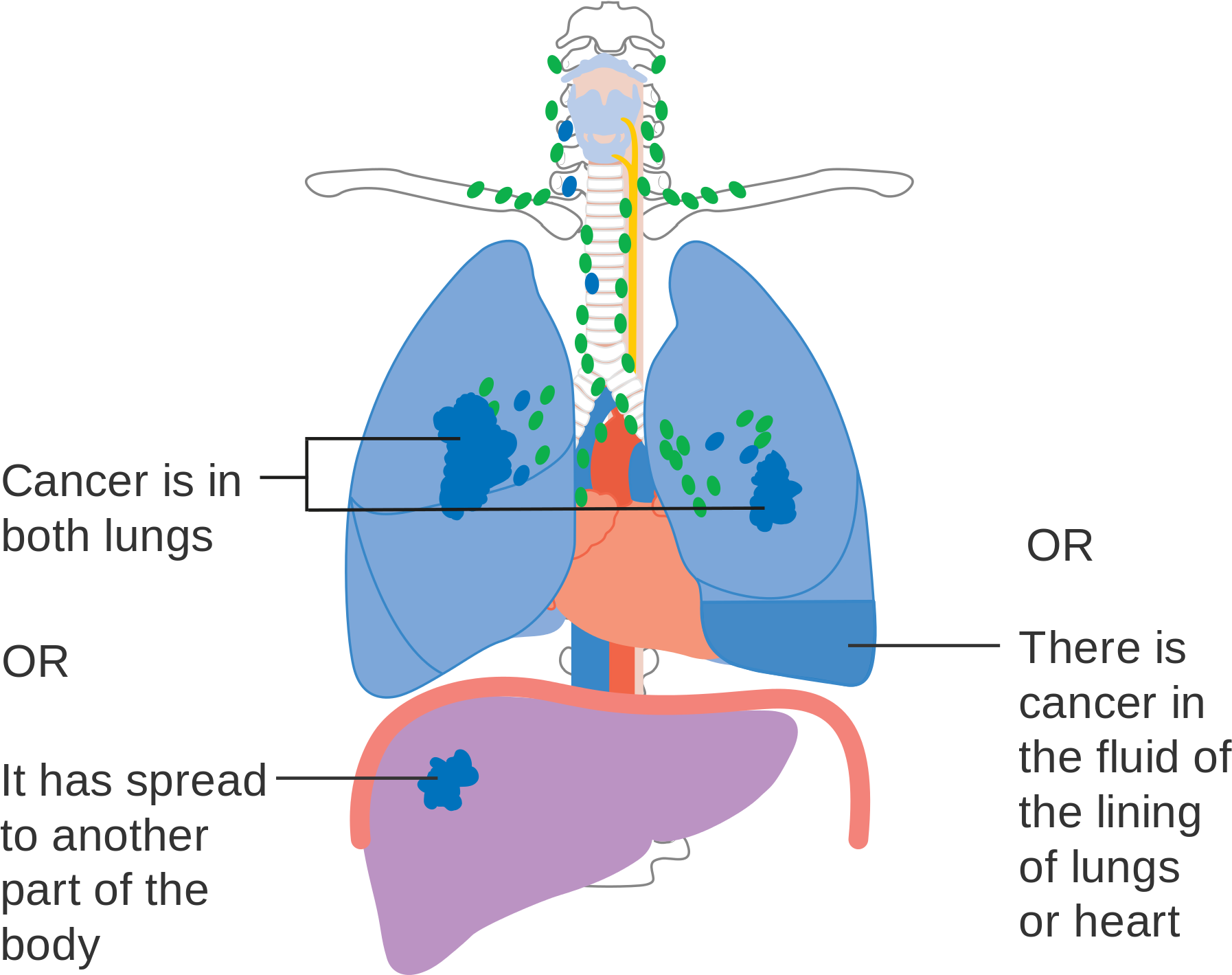 Tnm Staging Lung Cancer , Png Download - Stage 4 Lung Cancer Diagram Clipart (1794x1419), Png Download