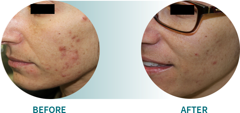 Active Acne/acne Scars - Smile Clipart (924x438), Png Download