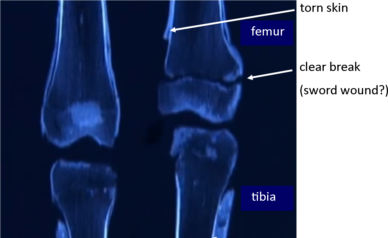 Tut's Leg Bones - King Tut Leg Fracture Clipart (1411x816), Png Download