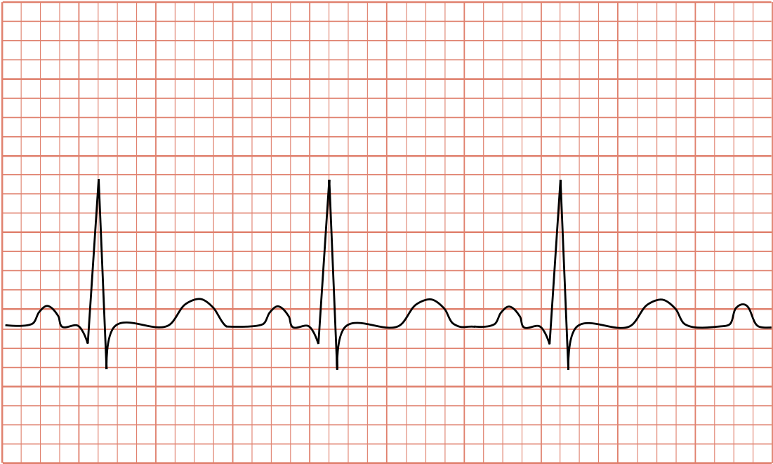 Tachycardia Svg Clipart (1200x711), Png Download