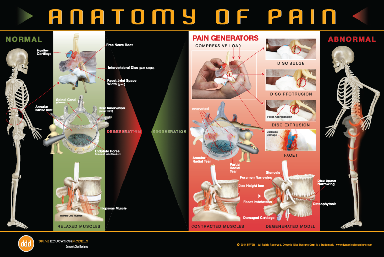 Anatomy Of Pain Poster - Disc Herniation Posters Clipart (784x524), Png Download