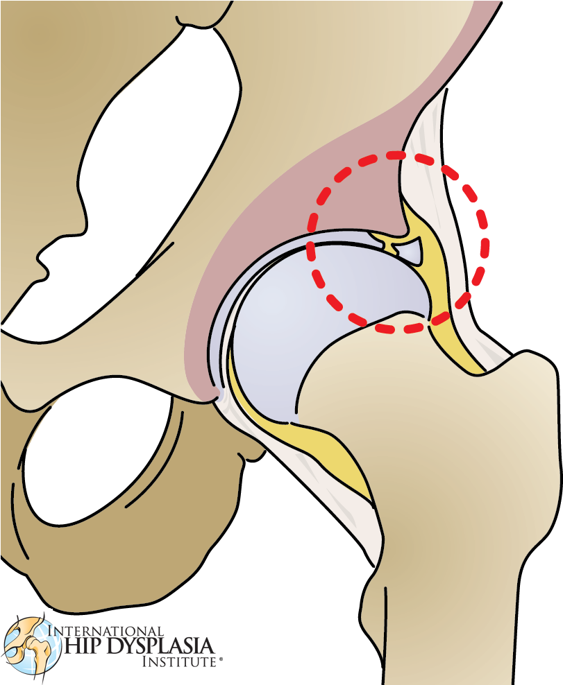 Black And White Library Labrum International Hip Dysplasia - Drawing Of Torn Labrum Hip Clipart (841x987), Png Download