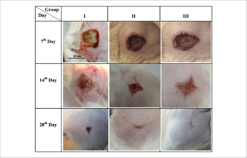 Skin Photographs Of Second-degree Burns Treated With - 10th Degree Burn Clipart (850x544), Png Download