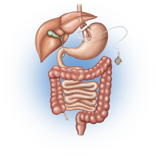 Your Ultimate Goal Of Weight Loss Surgery Is To Live - Vertical Sleeve Gastrectomy Clipart (596x595), Png Download