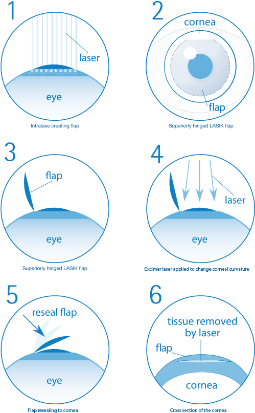 Are You Suitable For Laser Eye Surgery - Does Laser Eye Surgery Work Clipart (500x813), Png Download