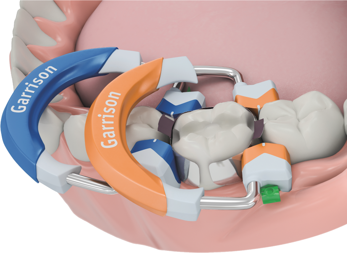 Garrison Dental 3d Fusion Diagram Clipart (1635x1104), Png Download