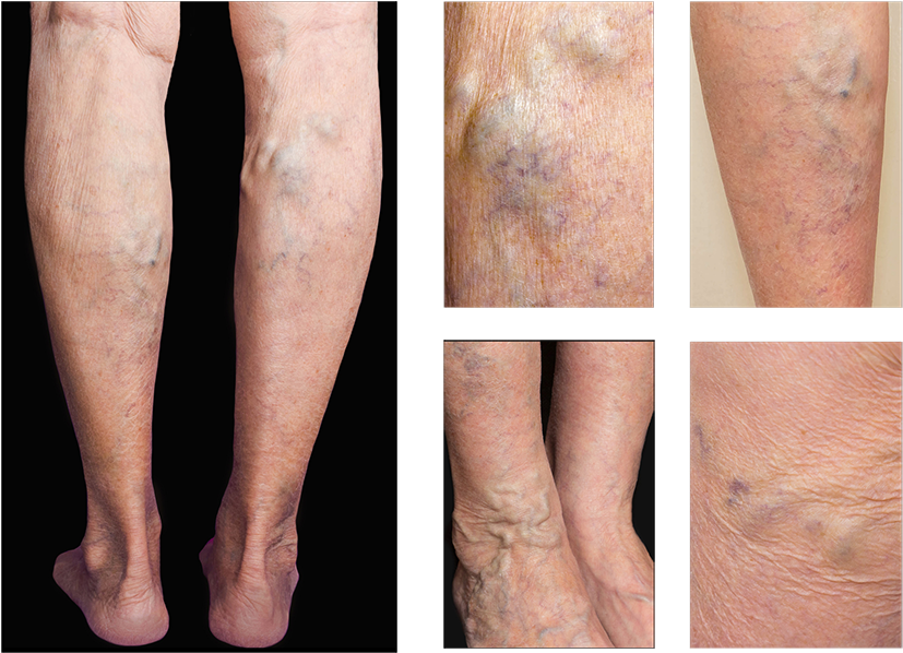 Varicose Veins - Scar Clipart (900x628), Png Download