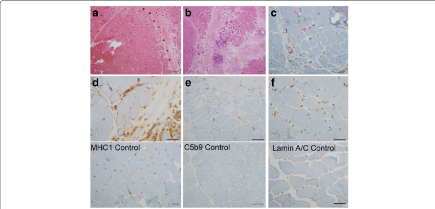 A Hematoxylin Eosin Staining Shows Prominent Perifascicular - Tile Clipart (850x408), Png Download