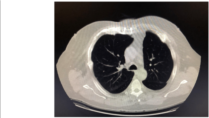 Follow-up Tomography 9 Months Postop, Showing Resolution - Carving Clipart (850x385), Png Download