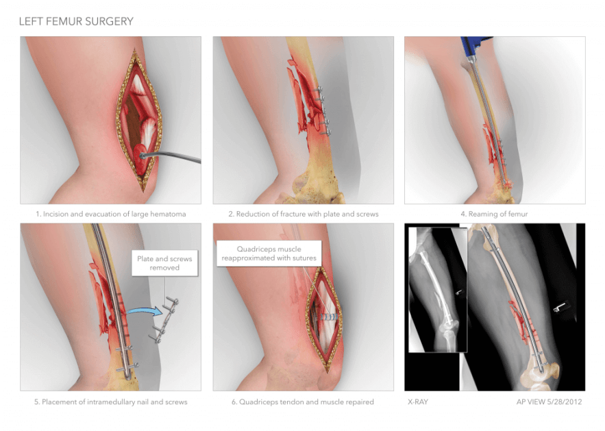 Left Femur Intramedullary Nailing - Intramedullary Nailing Of Femur Fractures Clipart (1200x628), Png Download