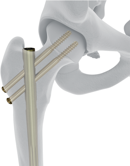 Femoral Recon Nail - Putter Clipart (868x559), Png Download