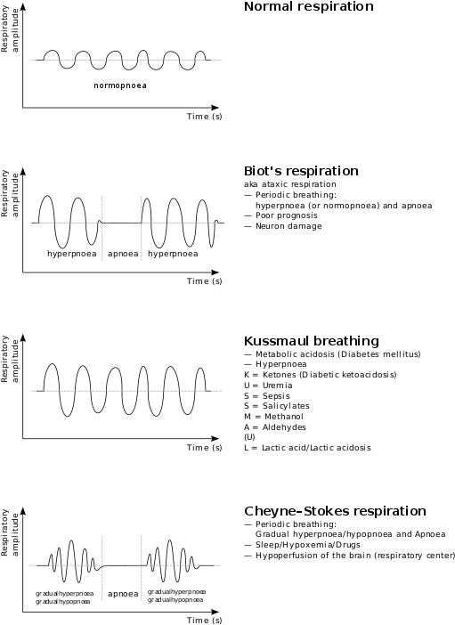 170 × 240 Pixels - Kussmaul Breathing Clipart (543x768), Png Download