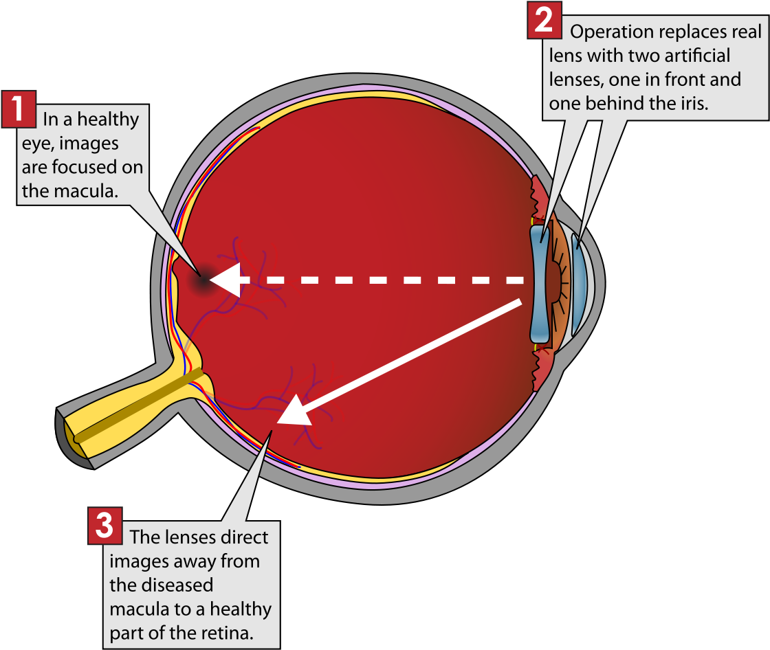 Implantable Miniature Telescope Diagram , Png Download - Implantable Miniature Telescope Diagram Clipart (1120x946), Png Download