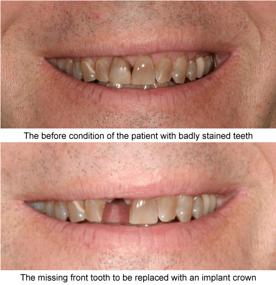 Before And After Case Examples All Of These Cases Shown - Tongue Clipart (560x868), Png Download