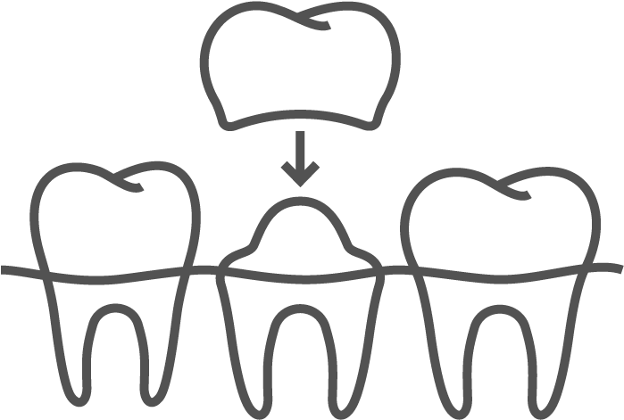 Crowns & Bridges - Protesis Dental Vectores Clipart (842x618), Png Download