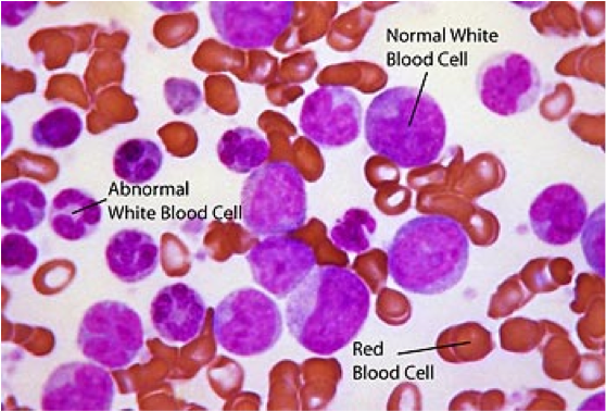 When The Leukemia Cells Crowd Out Your Normal Cells, - Blast Cell In Cml Clipart (769x663), Png Download