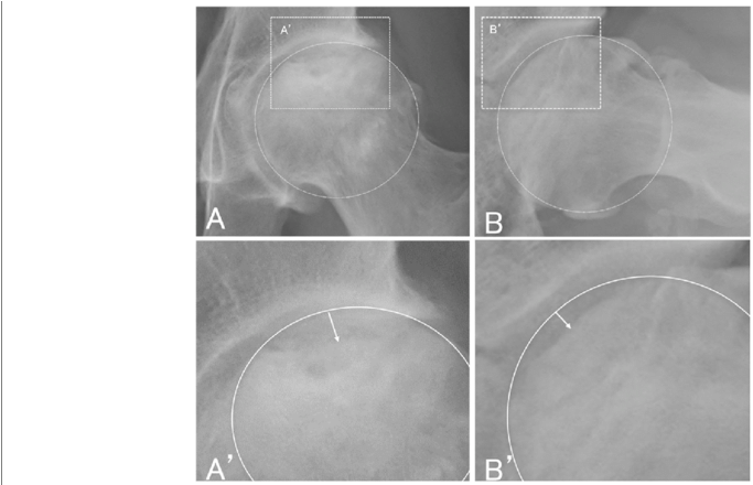 Measurement Of Femoral Head Collapse - Circle Clipart (850x439), Png Download