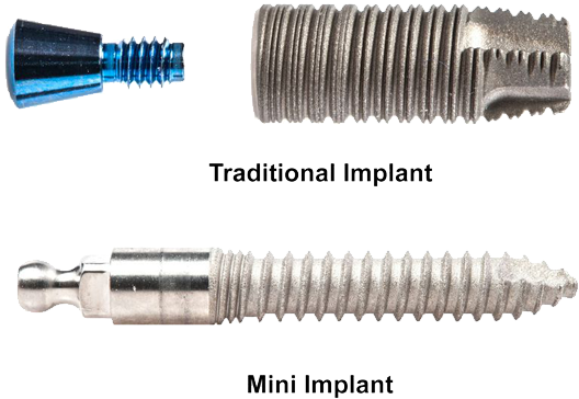 Mini Dental Implant Candidates - Dental Implant Clipart (900x500), Png Download