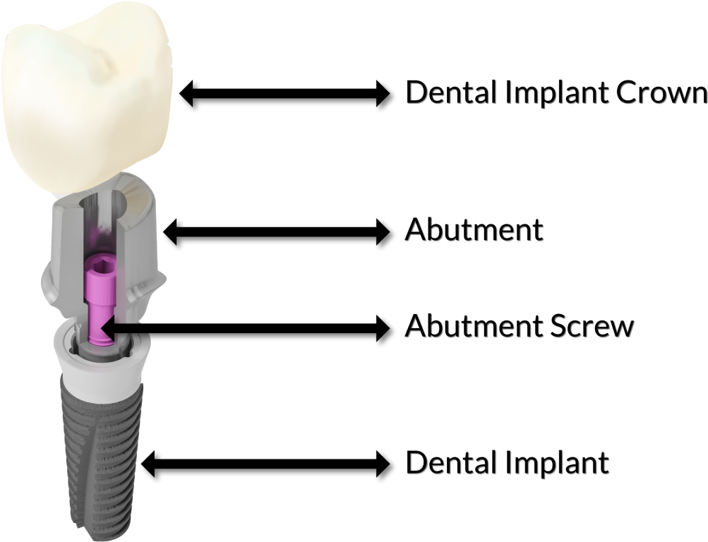 What Is The Difference Between A Dental Crown And A - Cutting Tool Clipart (1024x839), Png Download